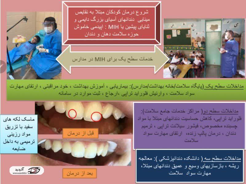 آغاز درمان کودکان مبتلا به نقایص مینایی دندانهای مولر – ثنایا (MIH) در استان اردبیل